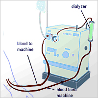 Dialysis Machine